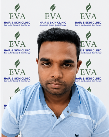 After hair transplant result 4
